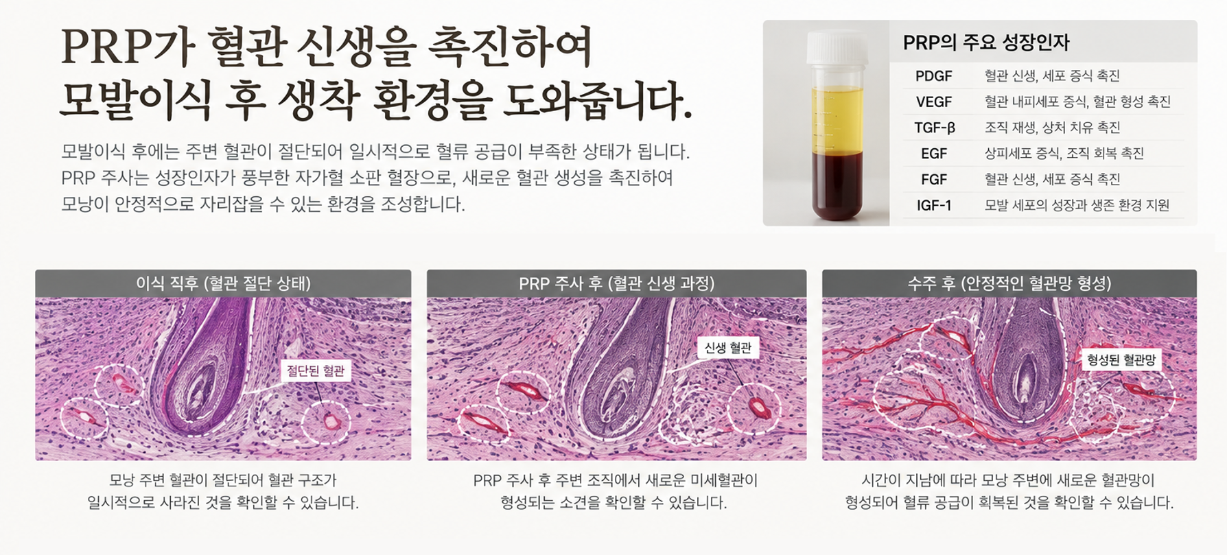 移植された毛包がもとの血管から切り離された状態を示す説明図